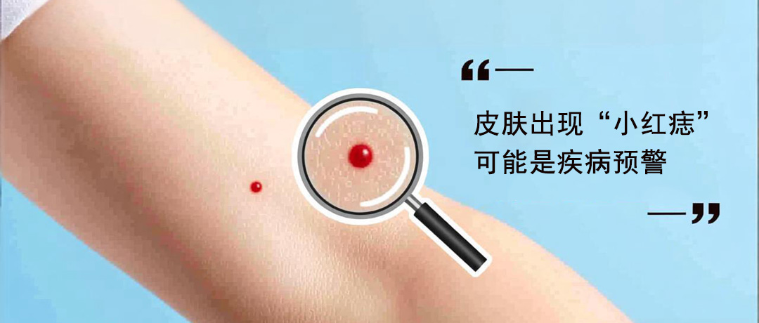 皮肤出现“小红痣”?可能是疾病预警