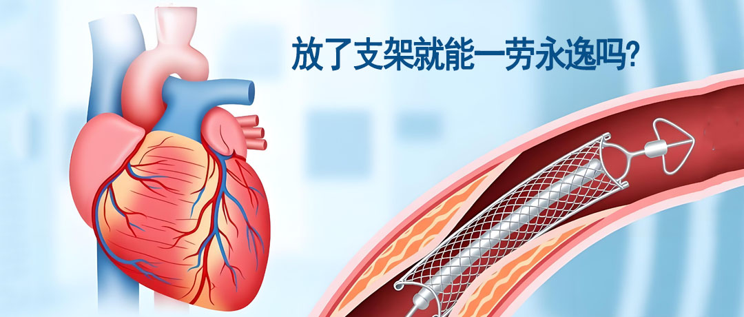 心脏放了支架，就能一劳永逸吗?