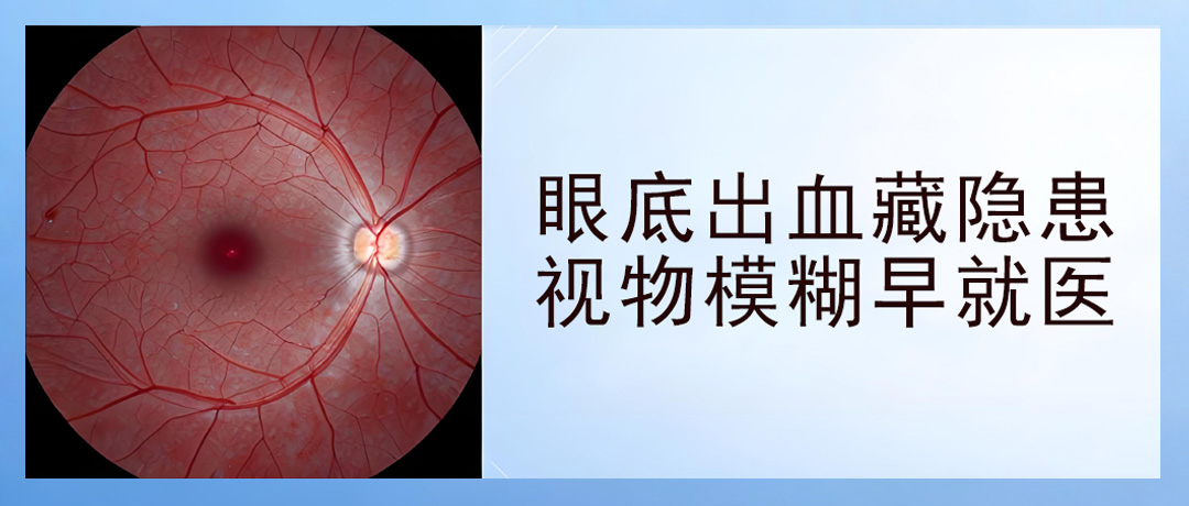 眼底出血能自行恢复吗?视物模糊务必及时就医