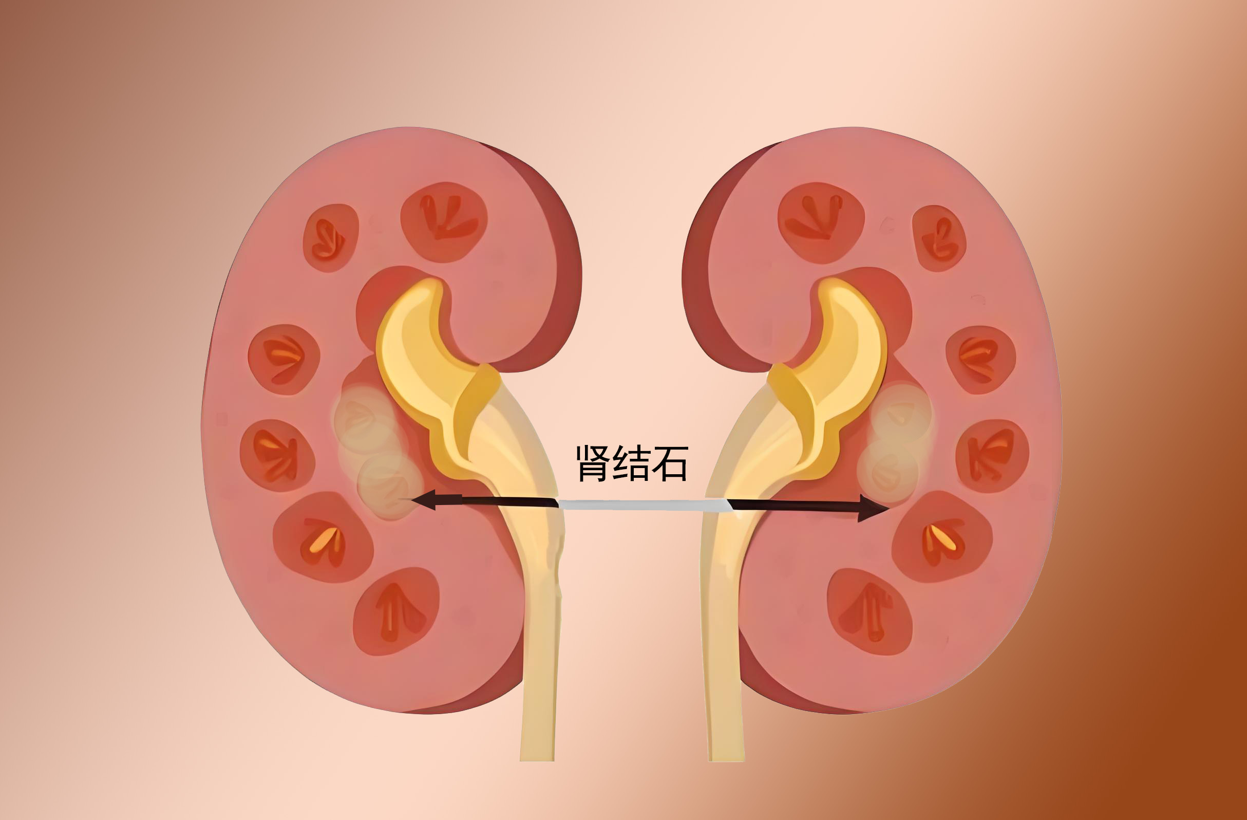 肾结石发作很痛苦，出现这些前兆提前做好防范