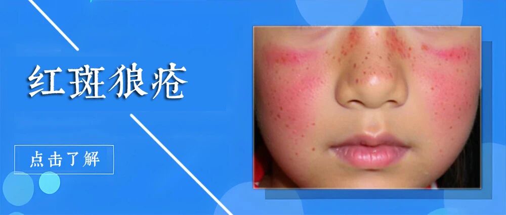 红斑狼疮会累及内脏吗?出现这些症状，要提高警惕