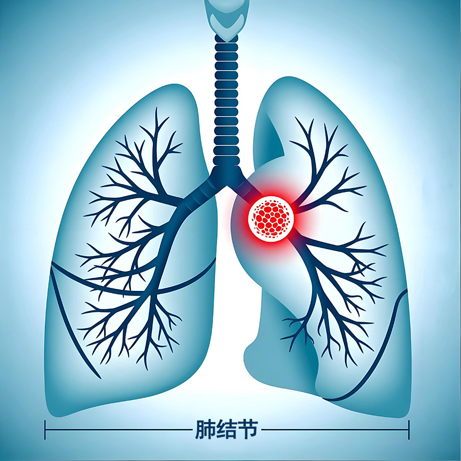 肺结节会不会癌变?看这几个判断标准，心里就有数了