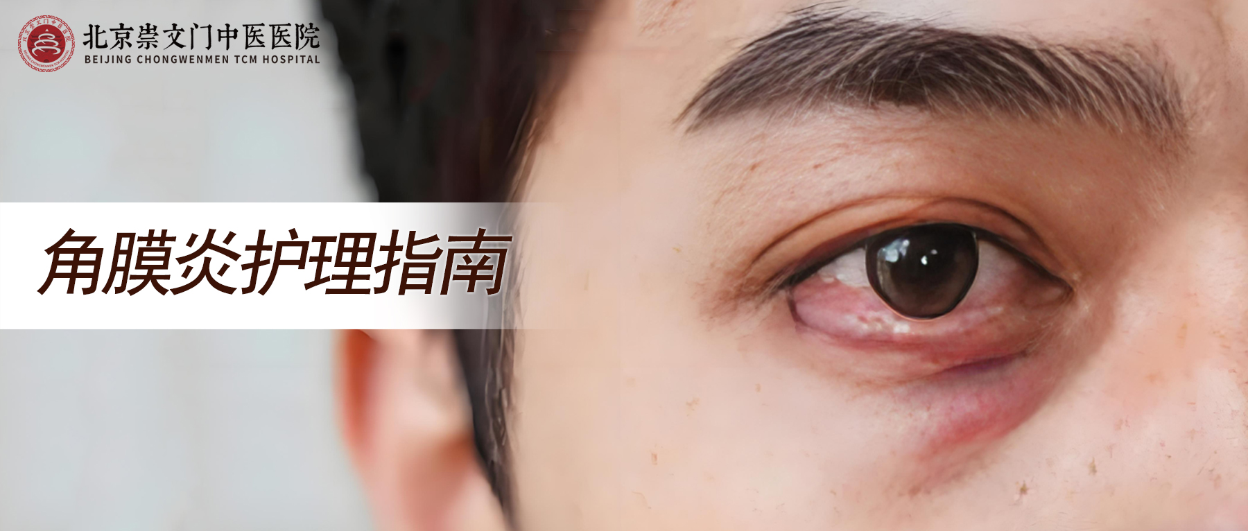 角膜炎拖久了伤视力，眼睛疼畏光别硬扛，这些因素要注意避开